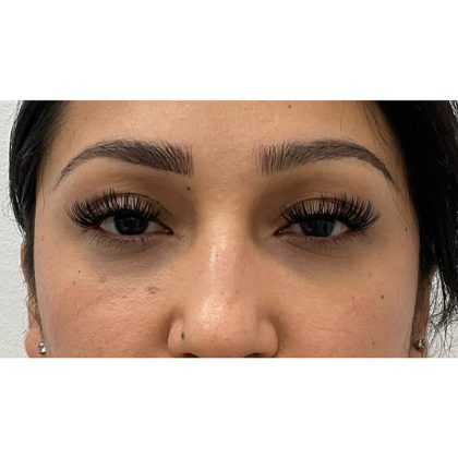 Under Eye Fillers Before & After Patient #3664