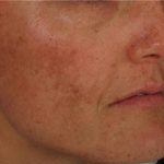 Nouvaderm Before & After Patient #3693