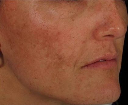 Nouvaderm Before & After Patient #3693