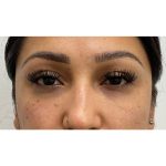 Under Eye Fillers Before & After Patient #3664
