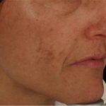 Nouvaderm Before & After Patient #3693