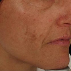 Nouvaderm Before & After Patient #3693