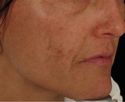 Nouvaderm Before & After Patient #3693