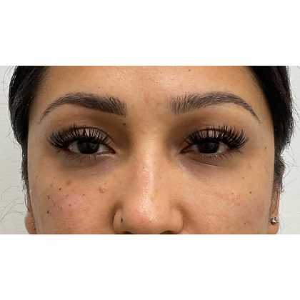 Under Eye Fillers Before & After Patient #3664