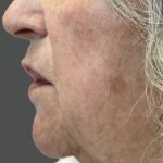 Nouvaderm Before & After Patient #3694