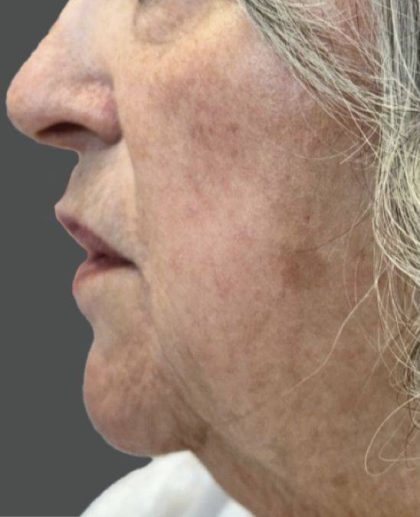 Nouvaderm Before & After Patient #3694