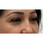 Under Eye Fillers Before & After Patient #3664