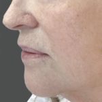 Nouvaderm Before & After Patient #3694