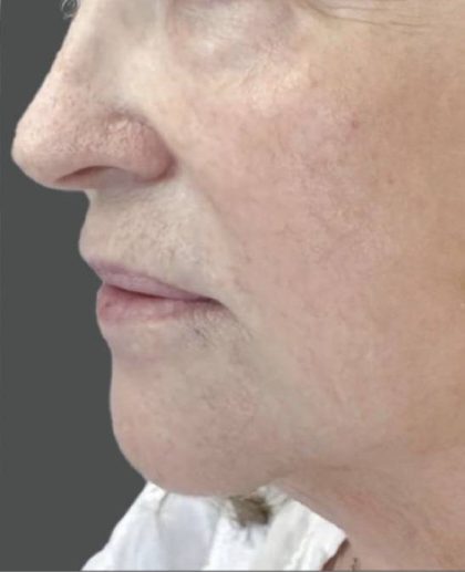 Nouvaderm Before & After Patient #3694