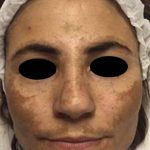 Nouvaderm Before & After Patient #3695