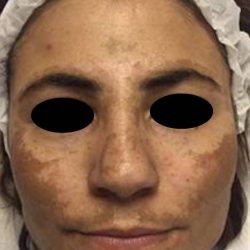 Nouvaderm Before & After Patient #3695