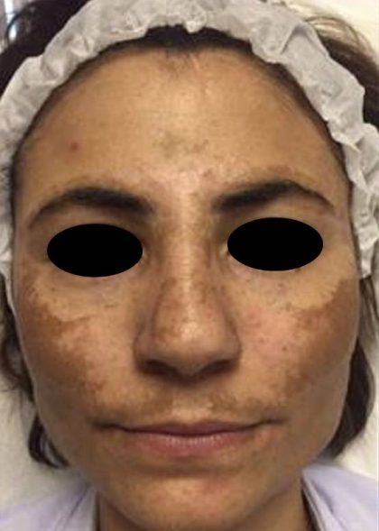 Nouvaderm Before & After Patient #3695