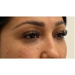 Under Eye Fillers Before & After Patient #3664