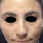 Nouvaderm Before & After Patient #3695