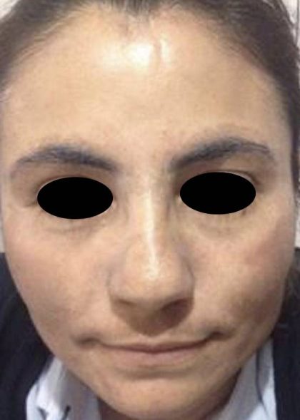 Nouvaderm Before & After Patient #3695