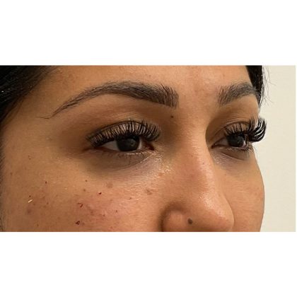 Under Eye Fillers Before & After Patient #3664