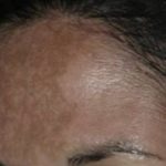 Nouvaderm Before & After Patient #3696