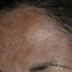 Nouvaderm Before & After Patient #3696
