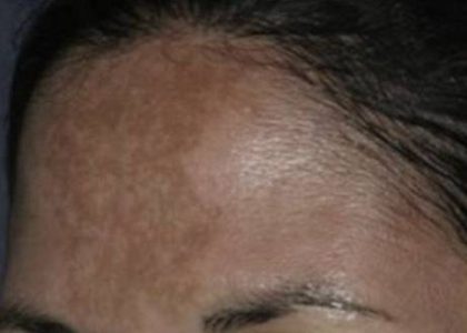 Nouvaderm Before & After Patient #3696