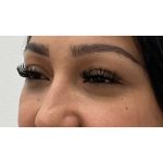 Under Eye Fillers Before & After Patient #3664