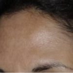 Nouvaderm Before & After Patient #3696