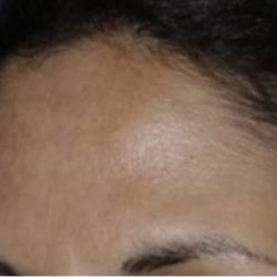 Nouvaderm Before & After Patient #3696