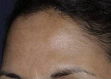 Nouvaderm Before & After Patient #3696