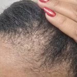 Nouvaderm Before & After Patient #3697