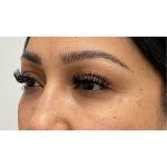 Under Eye Fillers Before & After Patient #3664