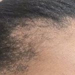 Nouvaderm Before & After Patient #3697