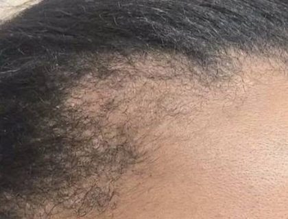 Nouvaderm Before & After Patient #3697
