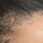 Nouvaderm Before & After Patient #3697