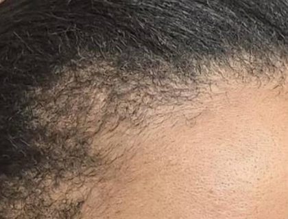 Nouvaderm Before & After Patient #3697