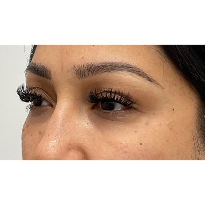 Under Eye Fillers Before & After Patient #3664