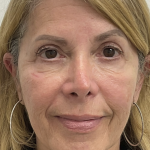Nouvaderm Before & After Patient #3757