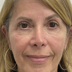 Nouvaderm Before & After Patient #3757