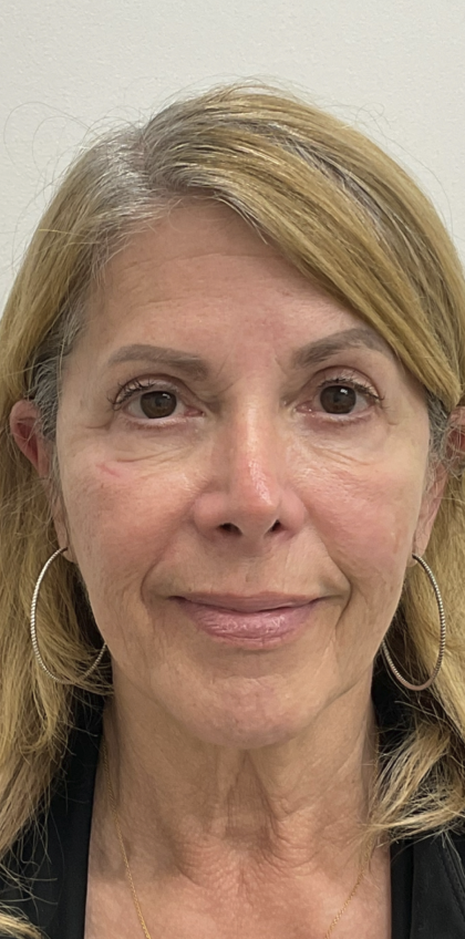 Nouvaderm Before & After Patient #3757