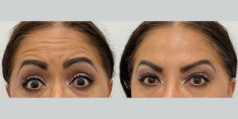 Before and After