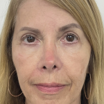 Nouvaderm Before & After Patient #3757