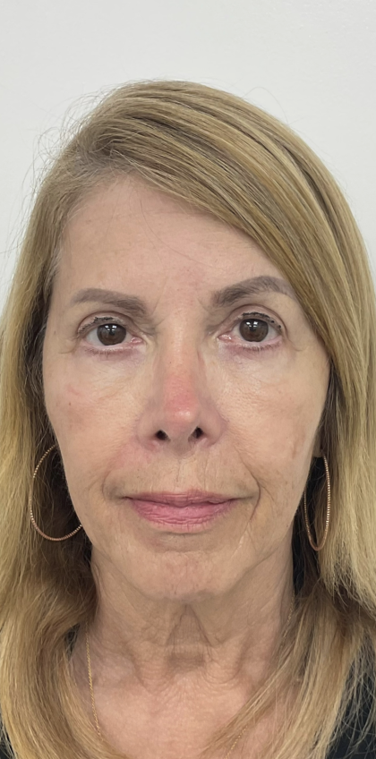 Nouvaderm Before & After Patient #3757