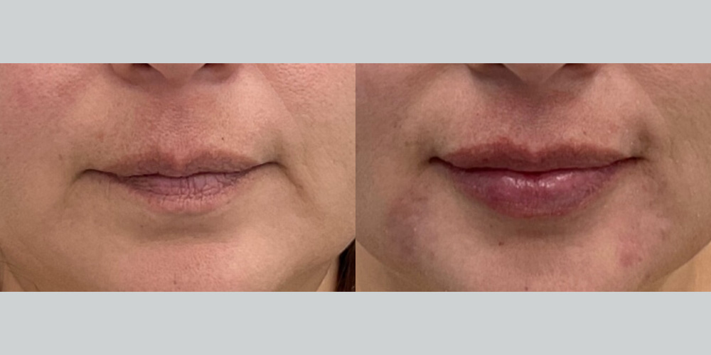 Before and After