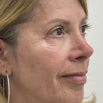 Nouvaderm Before & After Patient #3757