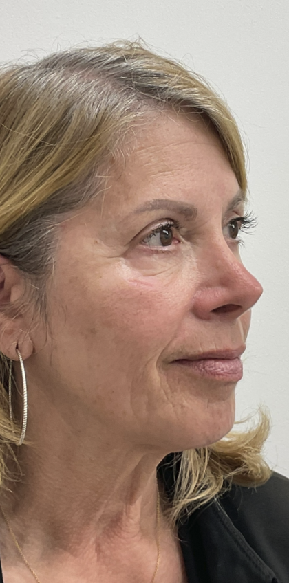 Nouvaderm Before & After Patient #3757