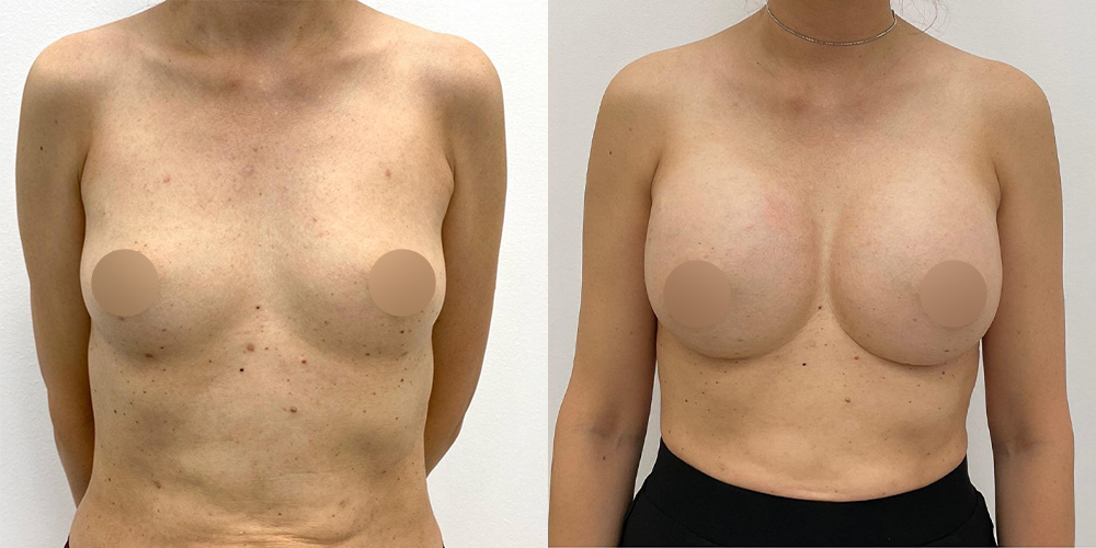 Before and After