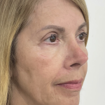 Nouvaderm Before & After Patient #3757
