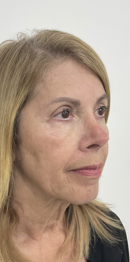 Nouvaderm Before & After Patient #3757