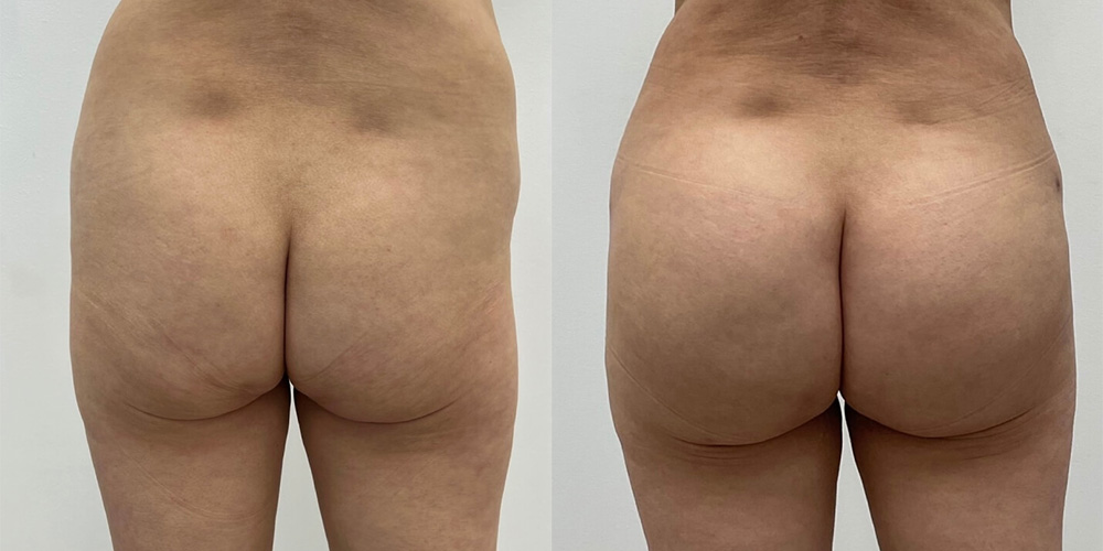 Before and After