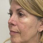 Nouvaderm Before & After Patient #3757