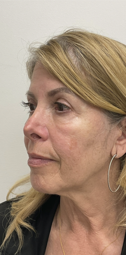 Nouvaderm Before & After Patient #3757