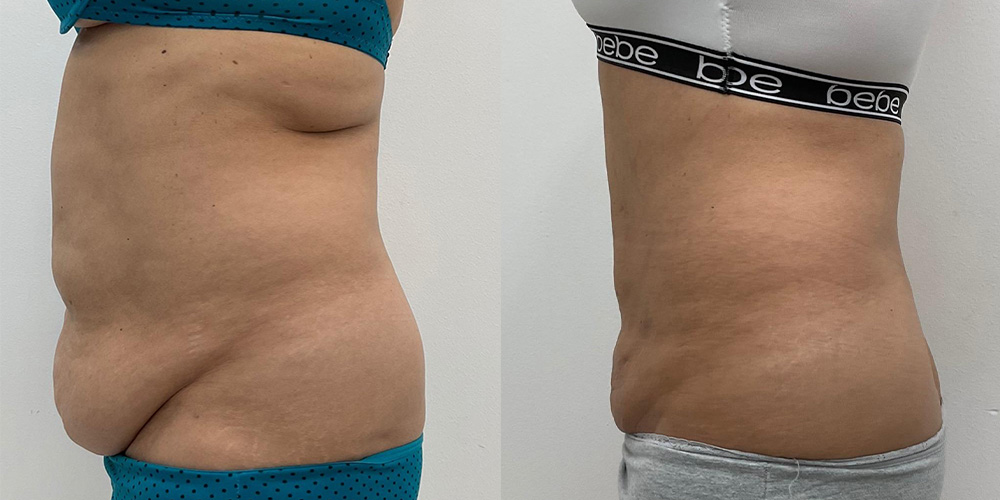 Before and After